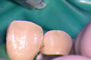 前歯のレジン充填 細い針で行き渡らせる2015.07.21.gif